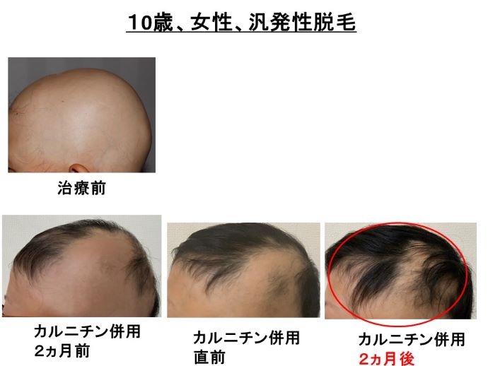 円形脱毛症　病院